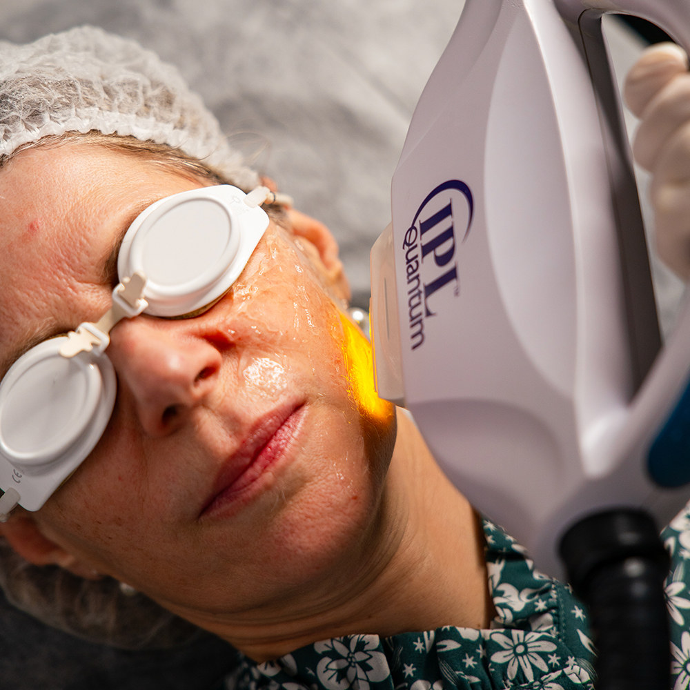 Tratamento IPL facial